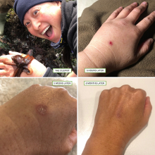 The progression of an octopus bite